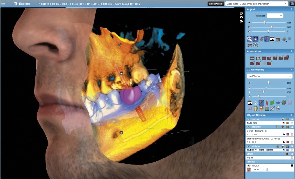 Tomograf 3D - rtg zębów Gdynia Planmeca proMax