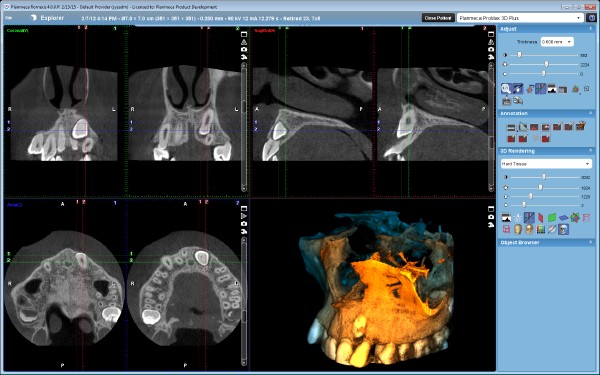 Tomograf 3D - planmeca rtg zębów Gdynia