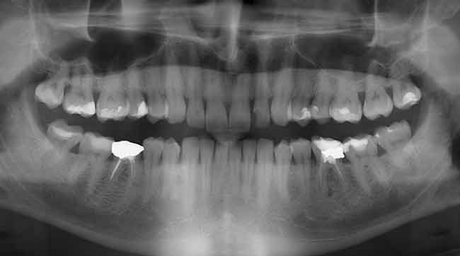 zdjęcie pantomograficzne - rtg zębów Gdynia