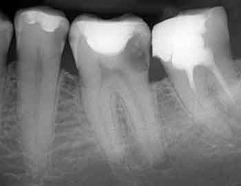 zdjęcie zęba -rtg zębów gdynia