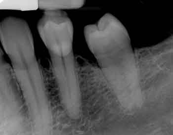 zdjęcie zęba -rtg zębów gdynia