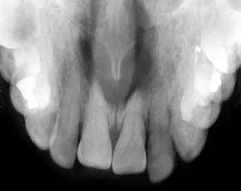 zdjęcie zgryzowe - rtg zębów gdynia